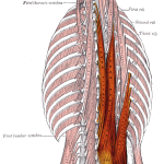 Deadlift injury to the spinal erector lower back muscles