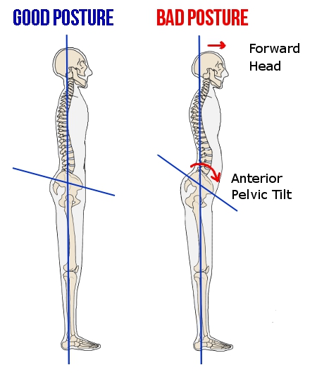 diagram demonstrating neutral correct posture and poor posture with anterior pelvic tilt
